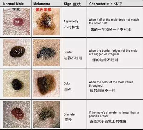 陰囊 黑痣|陰囊上的痣：是否需要切片檢查和去除？